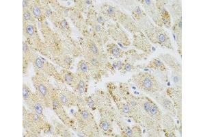 Immunohistochemistry of paraffin-embedded Human liver damage using HSD17B13 Polyclonal Antibody at dilution of 1:100 (40x lens).