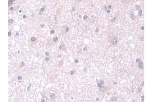 Detection of TPMT in Human Glioma Tissue using Polyclonal Antibody to Thiopurine Methyltransferase (TPMT)