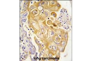 Formalin-fixed and paraffin-embedded human lung carcinoma tissue reacted with CYP8A1 antibody , which was peroxidase-conjugated to the secondary antibody, followed by DAB staining. (PTGIS anticorps  (N-Term))