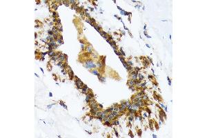 Immunohistochemistry of paraffin-embedded human breast using RAIDD/CRADD Rabbit mAb (ABIN7266107) at dilution of 1:100 (40x lens). (CRADD anticorps)