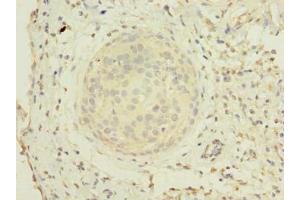 Immunohistochemistry of paraffin-embedded human cervical cancer using ABIN7176663 at dilution of 1:100