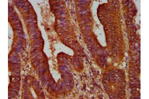 IHC image of ABIN7144528 diluted at 1:500 and staining in paraffin-embedded human colon cancer performed on a Leica BondTM system.