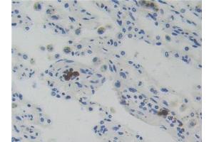 DAB staining on IHC-P; Samples: Human Lung Cancer Tissue (Glucocorticoid Receptor anticorps  (AA 598-755))