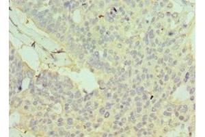 Immunohistochemistry of paraffin-embedded human endometrial cancer using ABIN7154113 at dilution of 1:100