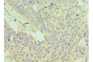 Immunohistochemistry of paraffin-embedded human endometrial cancer using ABIN7154113 at dilution of 1:100 (GSTO2 anticorps  (AA 124-243))