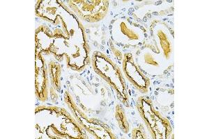 Immunohistochemistry of paraffin-embedded human kidney cancer using GLRX Antibody (ABIN6127980, ABIN6141147, ABIN6141149 and ABIN6220940) at dilution of 1:200 (40x lens). (Glutaredoxin 1 anticorps  (AA 1-106))