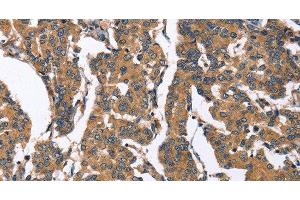 Immunohistochemistry of paraffin-embedded Human breast cancer tissue using BNIP2 Polyclonal Antibody at dilution 1:50