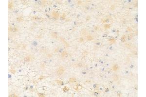 ABIN6258230 and ABIN6273626 at 1/100 staining human astrocytoma by IHC-P.