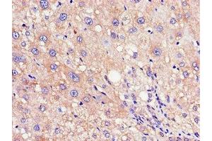 Immunohistochemistry of paraffin-embedded human liver cancer using ABIN7168030 at dilution of 1:100 (RND3 anticorps  (AA 152-239))