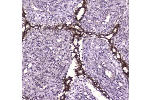 IHC testing of FFPE human breast cancer tissue with Glutathione Reductase antibody at 1ug/ml. (Glutathione Reductase anticorps)