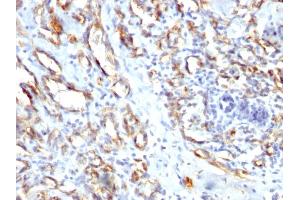 Formalin-fixed, paraffin-embedded human Angiosarcoma stained with CD31 Rabbit Polyclonal Antibody.