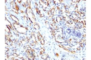 Formalin-fixed, paraffin-embedded human Angiosarcoma stained with CD31 Rabbit Polyclonal Antibody. (CD31 anticorps)