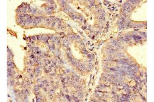 Immunohistochemistry of paraffin-embedded human endometrial cancer using ABIN7167899 at dilution of 1:100 (RIPOR2 anticorps  (AA 1-250))