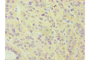 Immunohistochemistry of paraffin-embedded human liver cancer using ABIN7149265 at dilution of 1:100 (CYP3A5 anticorps  (AA 233-502))