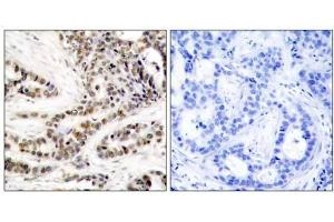 Immunohistochemical analysis of paraffin-embedded human breast carcinoma tissue using CREB (phospho-Ser129) antibody (E011273). (CREB1 anticorps  (pSer129))