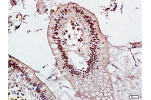 Formalin-fixed and adjacent noncancerous of human colon tissue labeled with Anti-Mel18/ZNF144 Polyclonal Antibody, Unconjugated  at 1:200 followed by conjugation to the secondary antibody and DAB staining