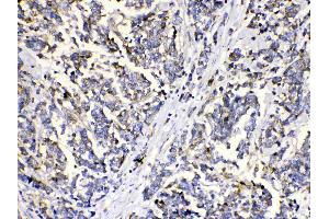 MUT was detected in paraffin-embedded sections of human mammary cancer tissues using rabbit anti- MUT Antigen Affinity purified polyclonal antibody (Catalog # ) at 1 µg/mL.