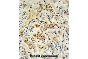 mouse BID Antibody (S61) (ABIN388100 and ABIN2846184) IHC analysis in formalin fixed and paraffin embedded human breast carcinoma followed by peroxidase conjugation of the secondary antibody and DAB staining. (BID anticorps  (AA 39-68))