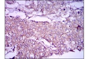 Immunohistochemical analysis of paraffin-embedded breast cancer tissues using GPC3 mouse mAb with DAB staining. (Glypican 3 anticorps)