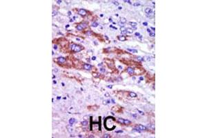 Formalin-fixed and paraffin-embedded human hepatocellular carcinoma tissue reacted with CSNK1D polyclonal antibody  , which was peroxidase-conjugated to the secondary antibody, followed by DAB staining. (Casein Kinase 1 delta anticorps  (C-Term))