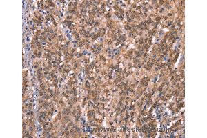 Immunohistochemistry of Human liver cancer using GCSAM Polyclonal Antibody at dilution of 1:40 (GCET2 anticorps)
