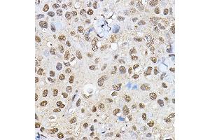 Immunohistochemistry of paraffin-embedded human breast cancer using p70 S6 Kinase 1 1 Rabbit pAb (ABIN7270029) at dilution of 1:100 (40x lens).