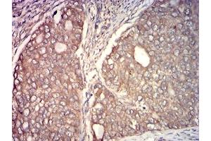 Immunohistochemical analysis of paraffin-embedded cervical cancer tissues using CAPN1 mouse mAb with DAB staining.