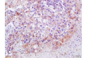 Formalin-fixed and paraffin embedded human lung carcinoma labeled with Anti-C5b-9 Polyclonal Antibody, Unconjugated (ABIN748913) at 1:200 followed by conjugation to the secondary antibody and DAB staining (C5b-9 anticorps)