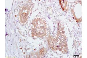 Formalin-fixed and paraffin embedded human breast carcinoma labeled with Anti-CD168/RHAMM Polyclonal Antibody, Unconjugated (ABIN1386755) at 1:200 followed by conjugation to the secondary antibody and DAB staining (HMMR anticorps  (AA 51-150))