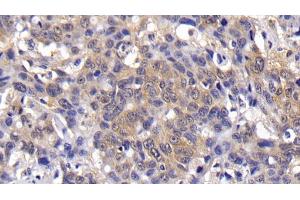 Detection of Bcl2L in Human Lymphoma Tissue using Polyclonal Antibody to B-Cell CLL/Lymphoma 2 Like Protein (Bcl2L)
