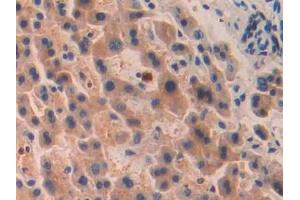 DAB staining on IHC-P; Samples: Human Liver cancer Tissue