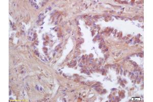Formalin-fixed and paraffin embedded human lung carcinoma labeled with Rabbit Anti FIS1/TTC11 Polyclonal Antibody, Unconjugated (ABIN872461) at 1:200 followed by conjugation to the secondary antibody and DAB staining