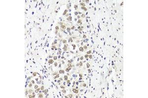 Immunohistochemistry of paraffin-embedded human esophageal cancer using PARP1 antibody at dilution of 1:100 (x40 lens).
