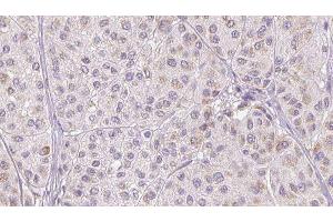ABIN6277329 at 1/100 staining Human melanoma tissue by IHC-P. (CFHR1 anticorps  (C-Term))