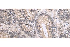 Immunohistochemistry of paraffin-embedded Human gastric cancer tissue using PPM1K Polyclonal Antibody at dilution of 1:55(x200) (PPM1K anticorps)