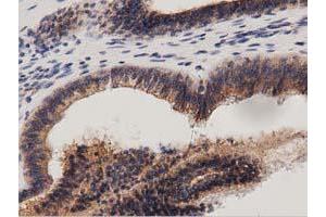 Immunohistochemical staining of paraffin-embedded Adenocarcinoma of Human ovary tissue using anti-PRKD2 mouse monoclonal antibody.