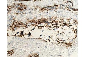 ABIN6277014 at 1/100 staining human lung carcinoma tissue sections by IHC-P.