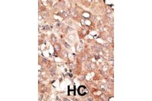 Formalin-fixed and paraffin-embedded human cancer tissue reacted with the primary antibody, which was peroxidase-conjugated to the secondary antibody, followed by DAB staining.