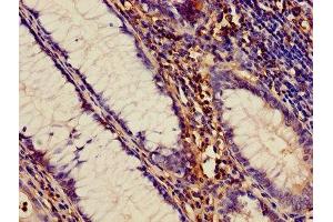Immunohistochemistry of paraffin-embedded human colon cancer using ABIN7150034 at dilution of 1:100 (A Disintegrin and Metallopeptidase Domain 1a (ADAM1A) (AA 214-504) anticorps)