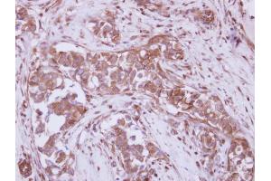IHC-P Image Immunohistochemical analysis of paraffin-embedded human breast cancer, using P2X7, antibody at 1:250 dilution.