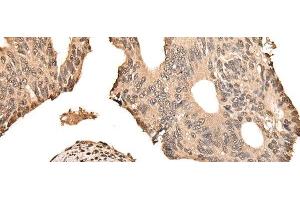 Immunohistochemistry of paraffin-embedded Human colorectal cancer tissue using ZSCAN12 Polyclonal Antibody at dilution of 1:50(x200) (ZSCAN12 anticorps)
