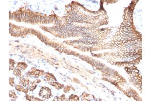 Formalin-fixed, paraffin-embedded human Pancreatic Carcinoma stained with TACSTD2 / TROP2 Mouse Monoclonal Antibody (TACSTD2/2151). (TACSTD2 anticorps  (AA 31-274))