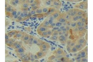 Detection of C2 in Human Liver cancer Tissue using Polyclonal Antibody to Complement Component 2 (C2) (Complement C2 anticorps  (AA 245-451))