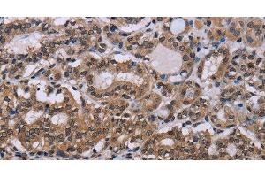 Immunohistochemistry of paraffin-embedded Human thyroid cancer tissue using DLX4 Polyclonal Antibody at dilution 1:50 (DLX4 anticorps)