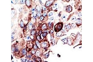 IHC analysis of FFPE human cancer tissue stained with the AXL antibody