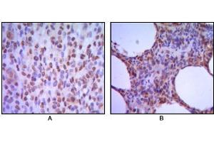 Immunohistochemical analysis of paraffin-embedded human melanoma (A), non-Hodgkin`s lymphoma (B), using MUM1 antibody with DAB staining. (MUM1 anticorps)