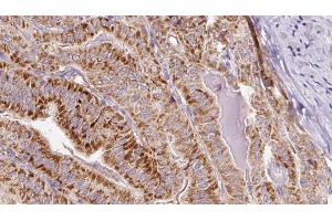 ABIN6267081 at 1/100 staining Human thyroid cancer tissue by IHC-P. (Connexin 43/GJA1 anticorps  (pSer262))