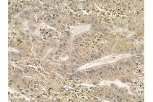 ABIN6262074 and ABIN6272312 at 1/100 staining human hepatocellular carcinoma by IHC-P. (GRAP anticorps  (C-Term))