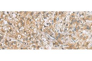 Immunohistochemistry of paraffin-embedded Human liver cancer tissue using DNPH1 Polyclonal Antibody at dilution of 1:60(x200) (RCL anticorps)
