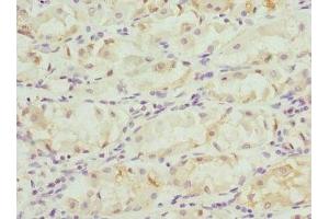 Immunohistochemistry of paraffin-embedded human gastric cancer using ABIN7153264 at dilution of 1:100 (FGD5 anticorps  (AA 1203-1462))